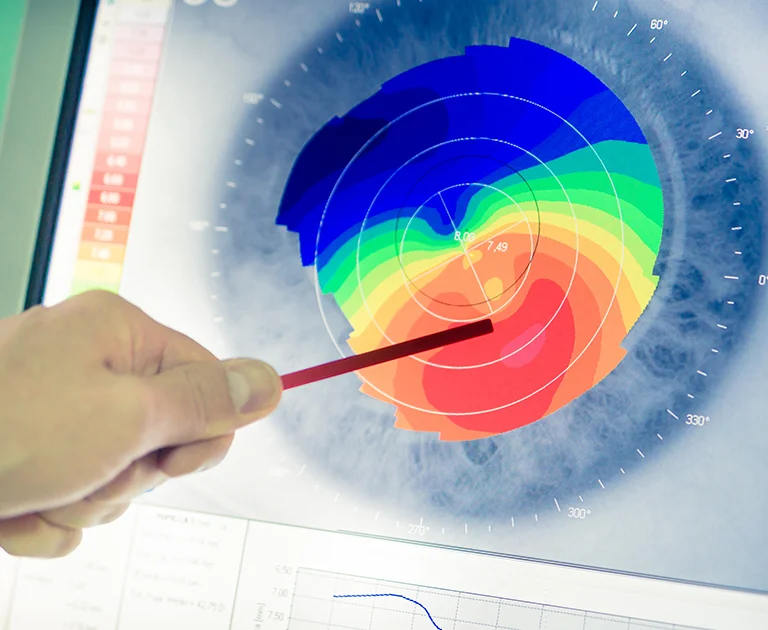 Keratoconus Laser Eye Surgery