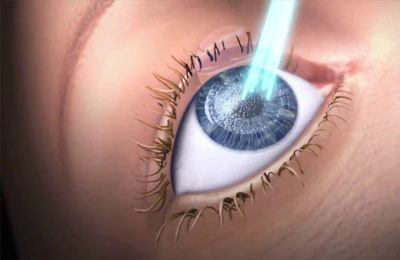 LASIK Eye Surgery London Eye Surgery UK Off